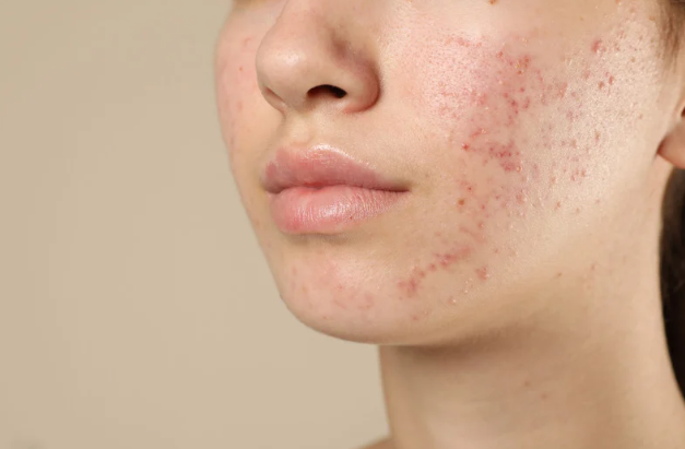 Acne Prone