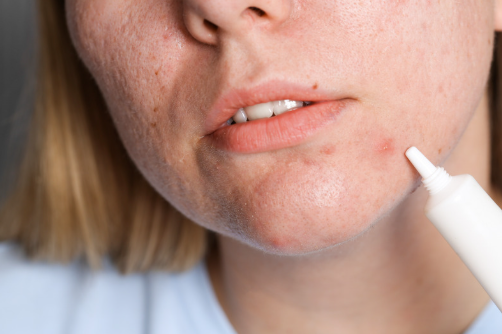 Acne Treatments