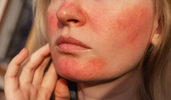Redness/Rosacea