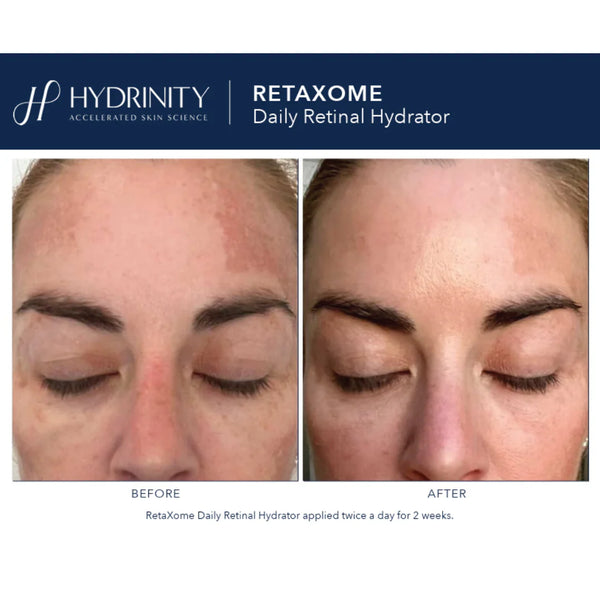 Hydrinity - RetaXome Daily Retinol HydratorRetaXome™ delivers the regenerative power of retinal encapsulated in a proprietary precision-targeted biomimetic exosome. This next-generation formula works synergistically to visibly smooth, firm, hydrate, and rejuvenate the skin.