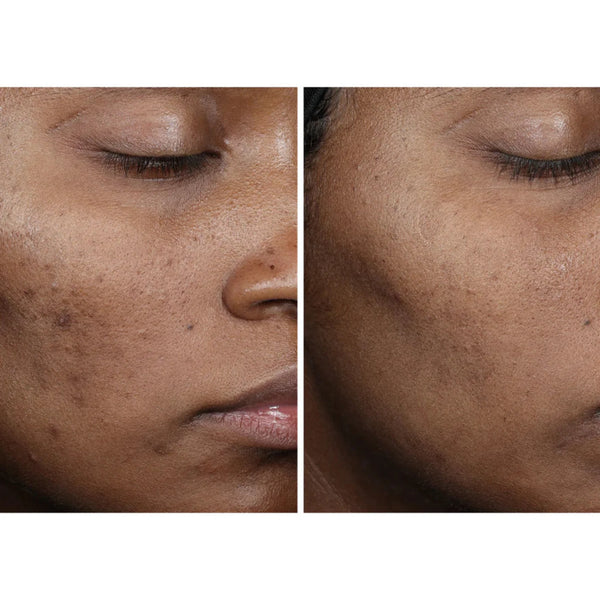 Ourself - Complexion Brightening Serum -  A stronger, faster approach to visibly smooth, even, and brighten skin - while reducing the appearance of discoloration and brown spots without hydroquinone or irritation. 77% felt smoother skin in 2 weeks. 87% saw improvement in discoloration and brown spots by Week 8.