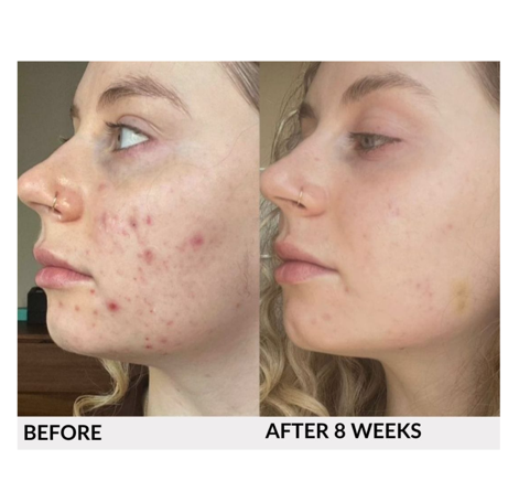 AO2 Skin® AO2 Clear is a revolutionary oxygen-based skincare treatment designed to help support clearer, healthier-looking skin through the power of patented Oxygen Nanobubble Technology®. Unlike traditional acne products that rely on harsh acids, benzoyl peroxide, antibiotics, or retinoids, AO2 Clear takes a minimalist, science-driven approach by delivering billions of microscopic oxygen nanobubbles—approximately 1,000 times smaller than the diameter of a pore—directly to the skin.