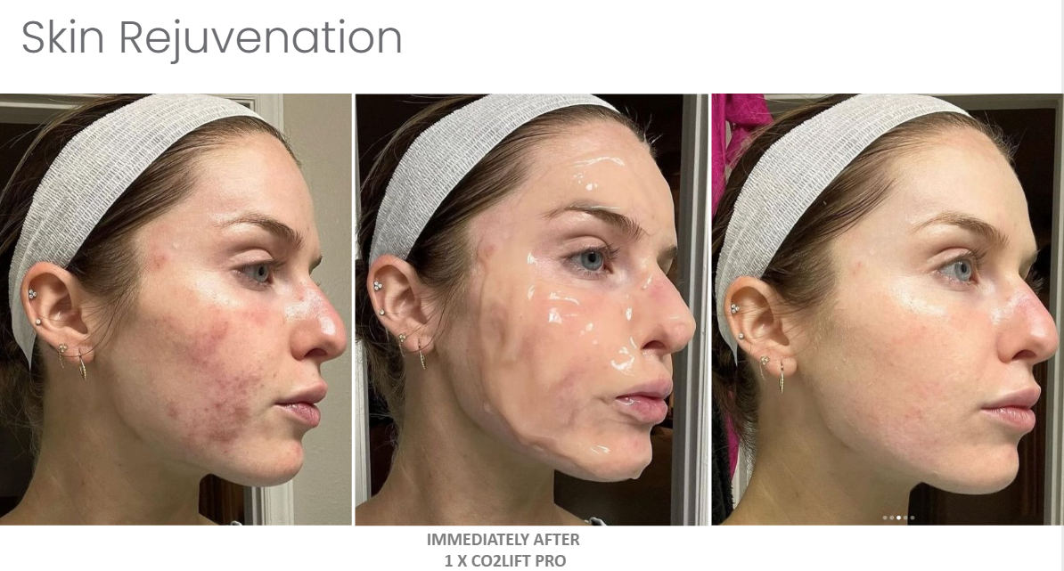 CO2LIFT - CO2Lift® Pro – Topical Carboxy Gel Oxygen Delivery System