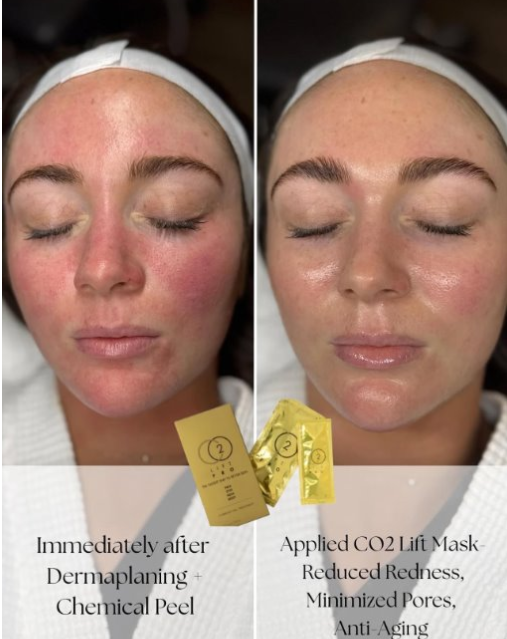CO2LIFT - CO2Lift® Pro – Topical Carboxy Gel Oxygen Delivery System