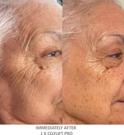 CO2LIFT - CO2Lift® Pro – Topical Carboxy Gel Oxygen Delivery System