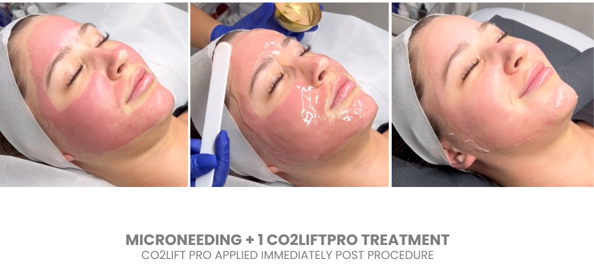 CO2LIFT - CO2Lift® Pro – Topical Carboxy Gel Oxygen Delivery System