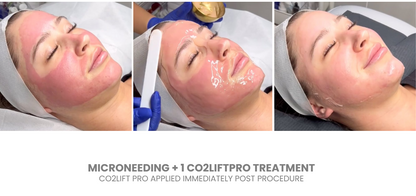 CO2LIFT - CO2Lift® Pro – Topical Carboxy Gel Oxygen Delivery System