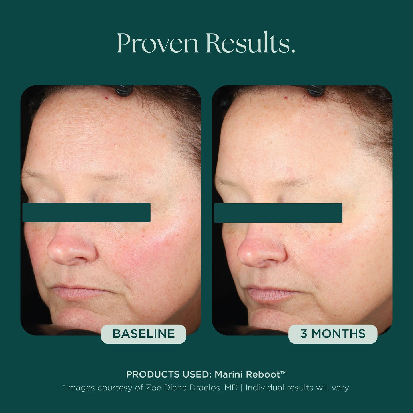 Marini SkinSolutions - Marini Reboot® PDRN Face Serum (1 oz)